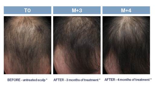 PHYTOLIUM+ Initial Stages Strengthening Treatment