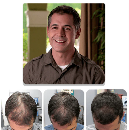 HAIR REGROWTH SYSTEM FOR MEN