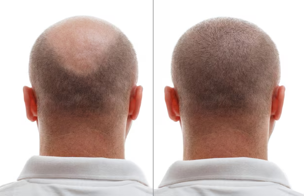 Hair Transplant