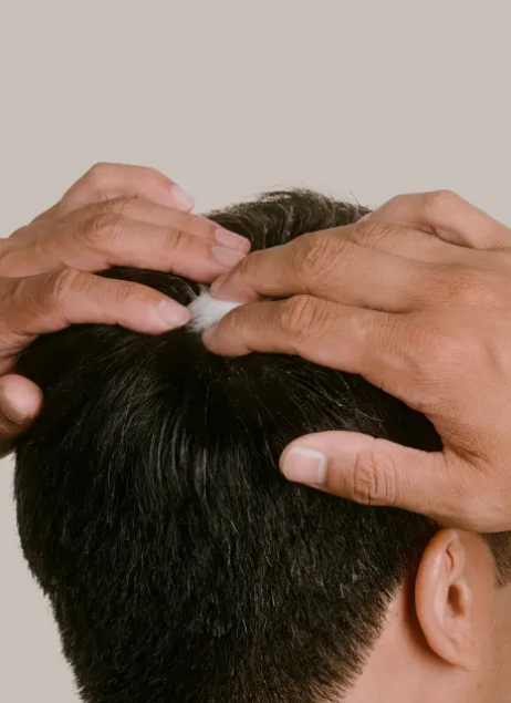 Topical Finasteride and Minoxidil Gel