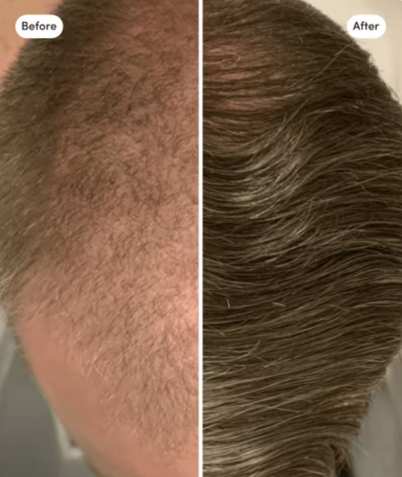 hims hair loss treatment